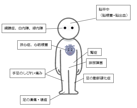 イラスト：糖尿病の合併症